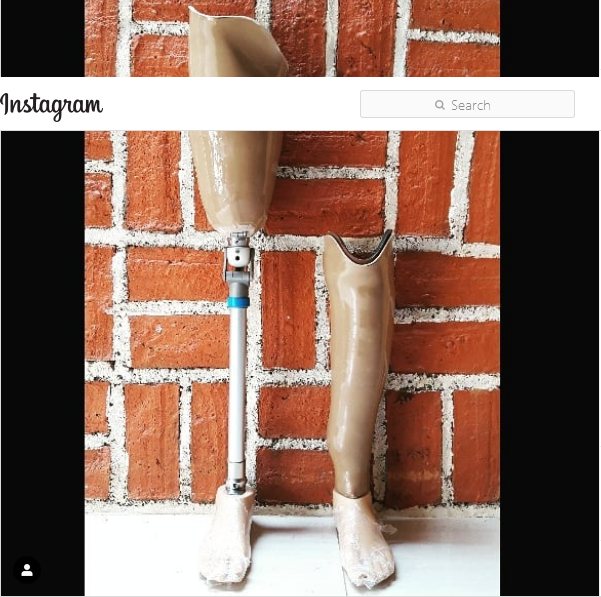 Bilateral Amputee Amputasi Di Bawah Lutut