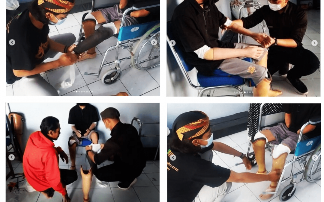 Bilateral Transtibial Amputee