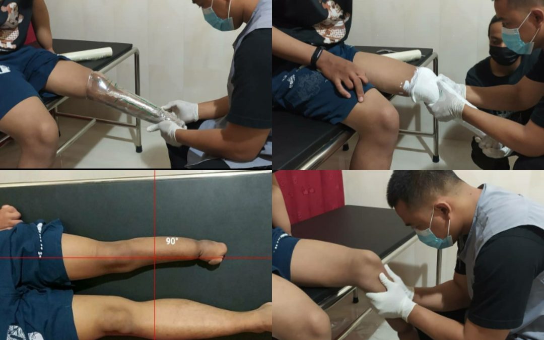 Pemeriksaan dan pengukuran Congenital Transtibial Amputee