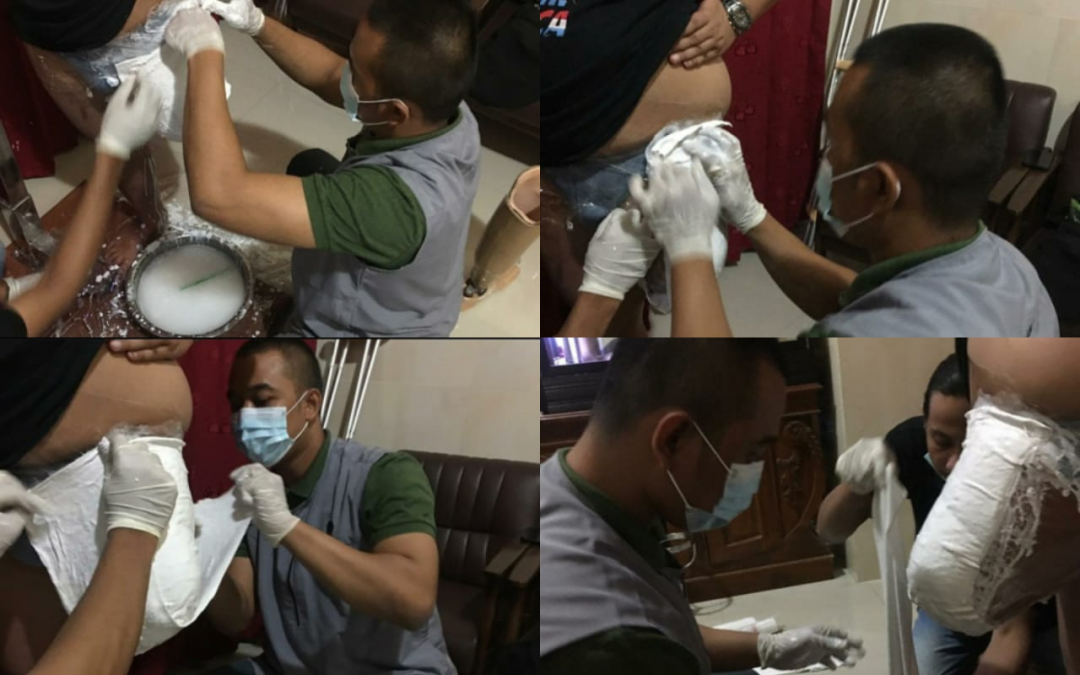 Pengukuran Kaki Prostesis Atas Lutut