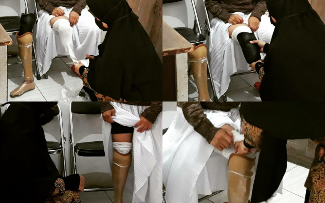 Kaki Prostesis Bawah Lutut Eksoskeletal