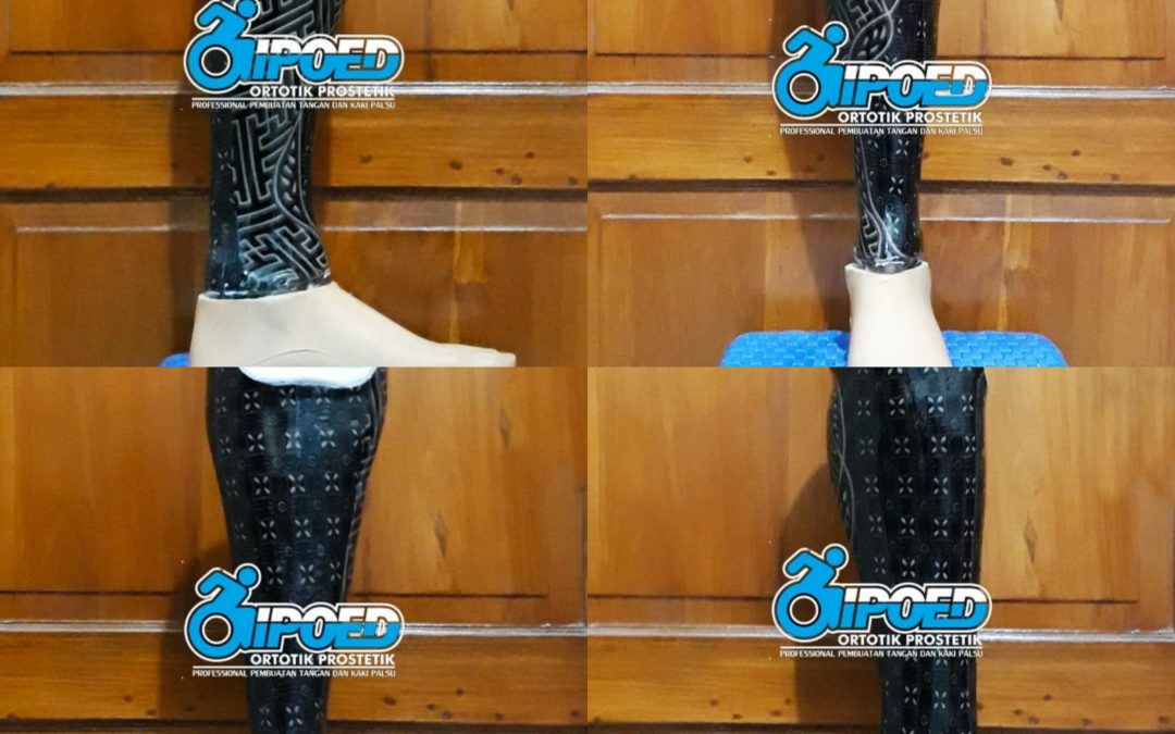 Kaki Prostesis Bawah Lutut