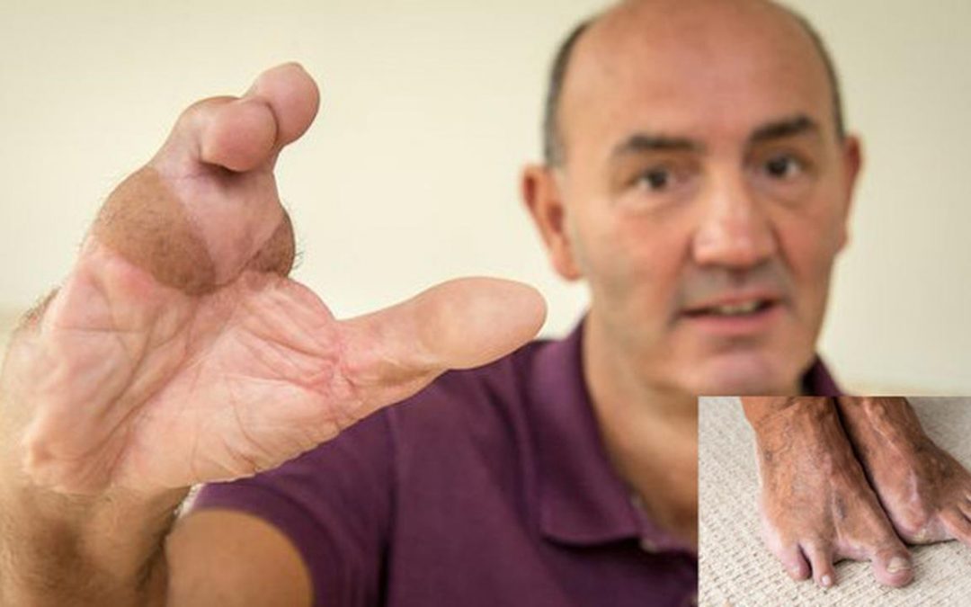 Jeremy Payton Ganti Jari Tangan dengan Jari Kaki