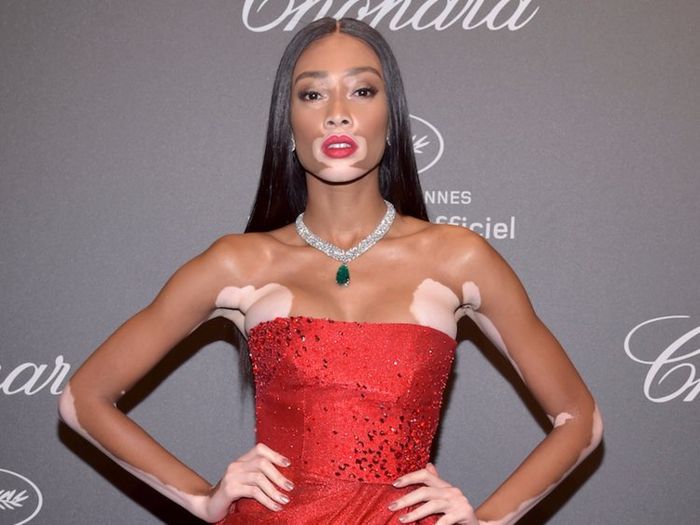 Winnie Harlow Sang Model Berkulit Belang