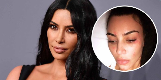 Kim Kardashian seorang bintang realitas TV, model, sosialita dan aktris berkebangsaan Amerika Serikat Yang Menderita Psoriasis