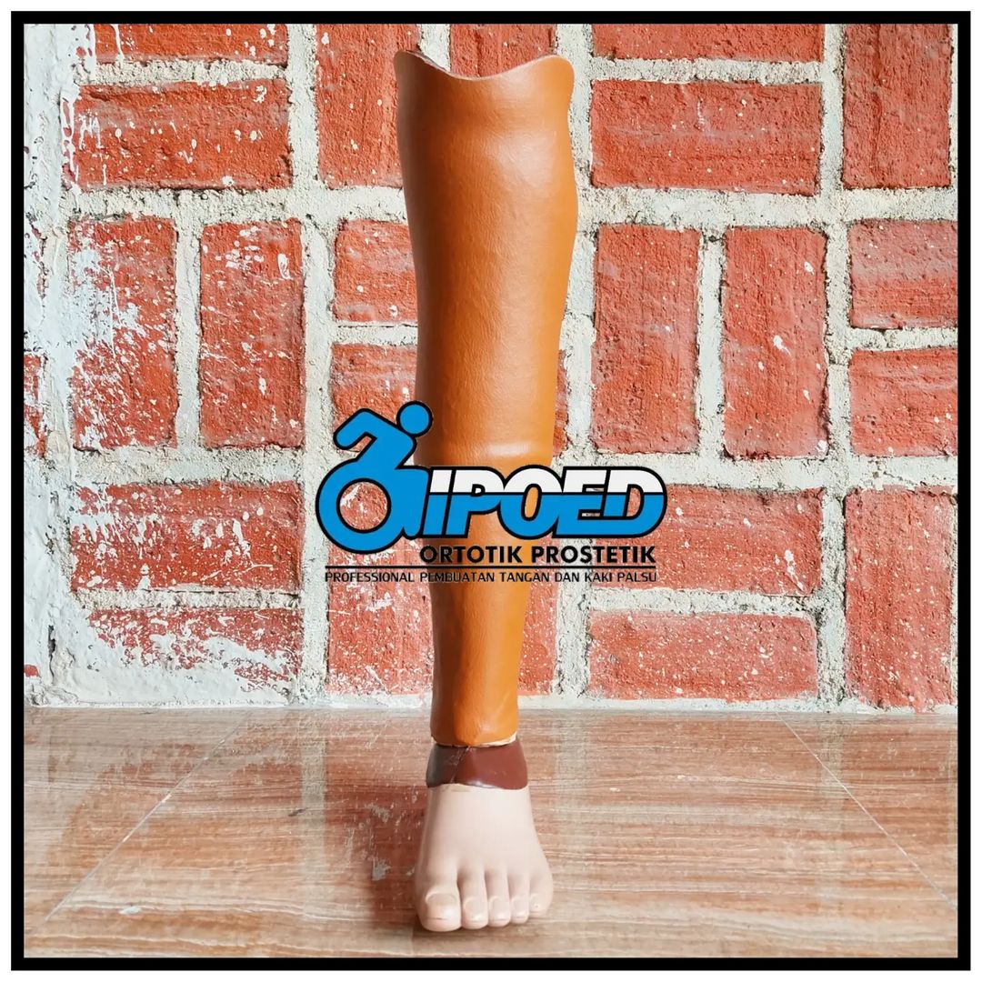 Transtibial Prosthesis