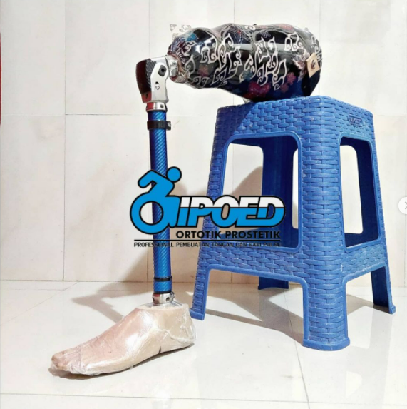 Transfemoral Prosthesis