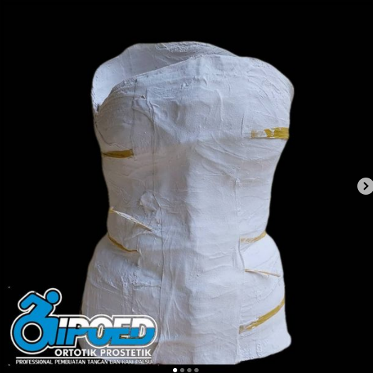 Negative Cast Spinal Orthosis