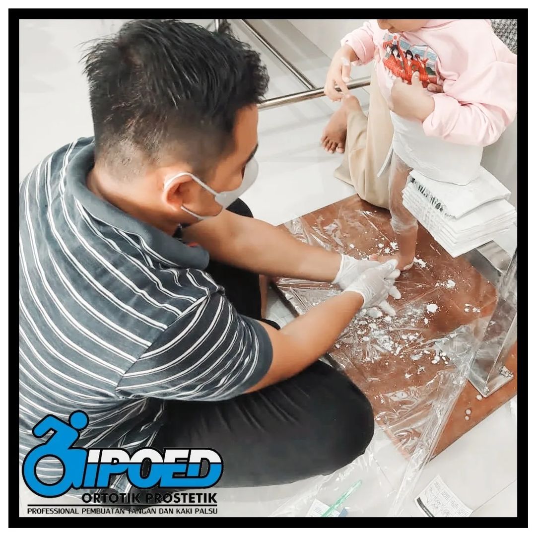 Congenital-Hip-Disarticulation