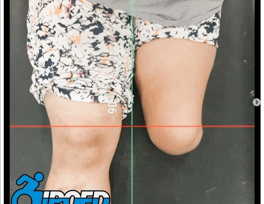 Knee Disarticulation Prosthesis