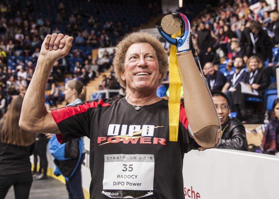 Bob Radocy Atlet Basket dengan Tangan Palsu