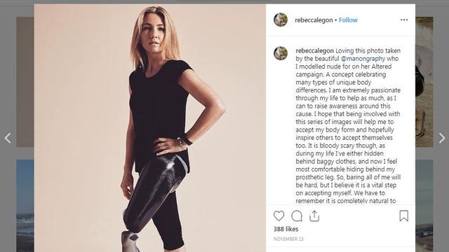 Sempat Putus Asa Kehilangan Kaki dan Jadi Disabilitas, Rebecca Legon Kini Bahagia