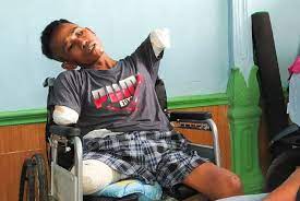 3 Tahun Bekerja di Malaysia, TKI Pulang dengan Kaki dan Tangan Buntung