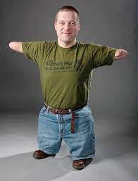 John Robinson, Pengusaha Tanpa Tangan dan mengidap penyakit smurf