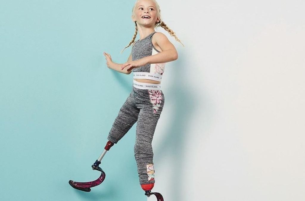 Model Cilik dengan Kaki Palsu di Kedua Kakinya