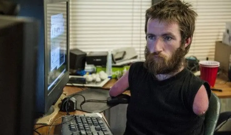 Michael Handi Olson, Gamers yang Kehilangan kaki dan tangan sejak kecil