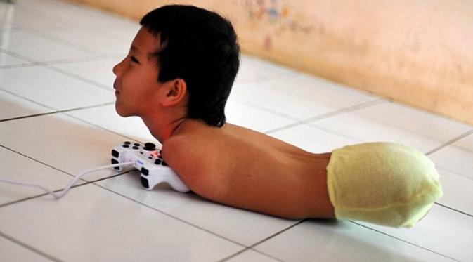 Tiyo Satrio ~ Semangatnya Tetap Tinggi Meski Tak Punya Lengan Dan Kaki