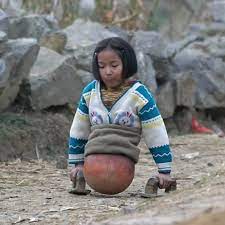 Kisah Perjuangan Gadis Tanpa Kaki hingga Jadi Atlet Renang Sukses