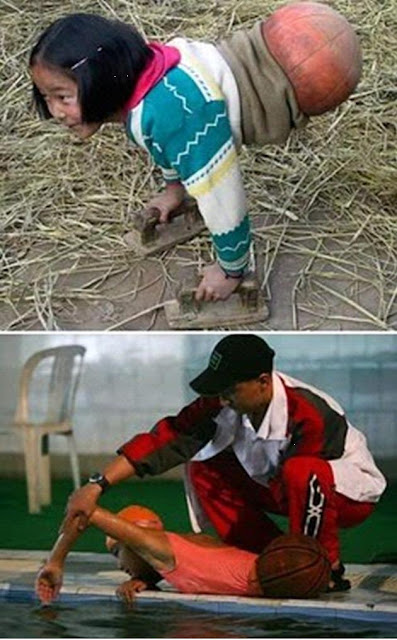 Gadis kecil yang harus menggunakan bola basket sebagai tubuh prostetik nya