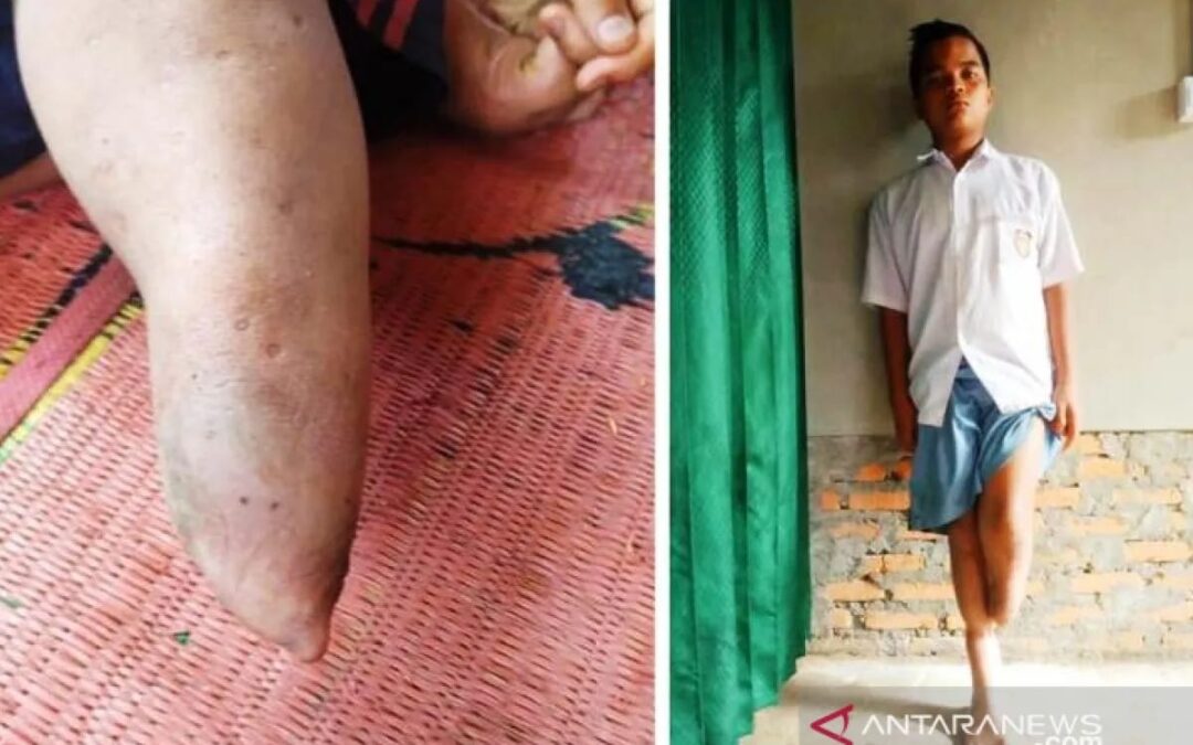 Kisah Seorang Pelajar Penyandang Disabilitas