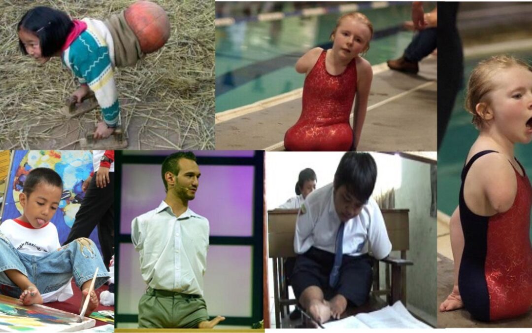 Penyandang Cacat Masih Tidak Dihargai