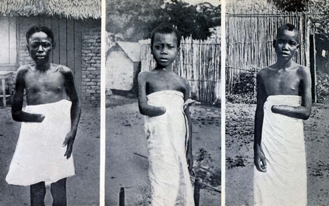 Kongo Kolonial Belgia: Seorang Ayah Budak Menatap Tangan dan Kaki Putrinya yang Terputus, 1904