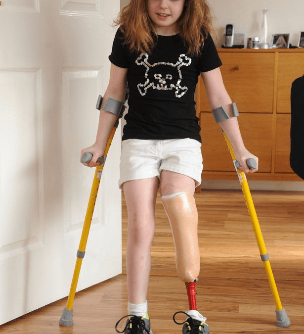 Keeley Menemukan Kegembiraan dalam Sepak Bola Amputasi