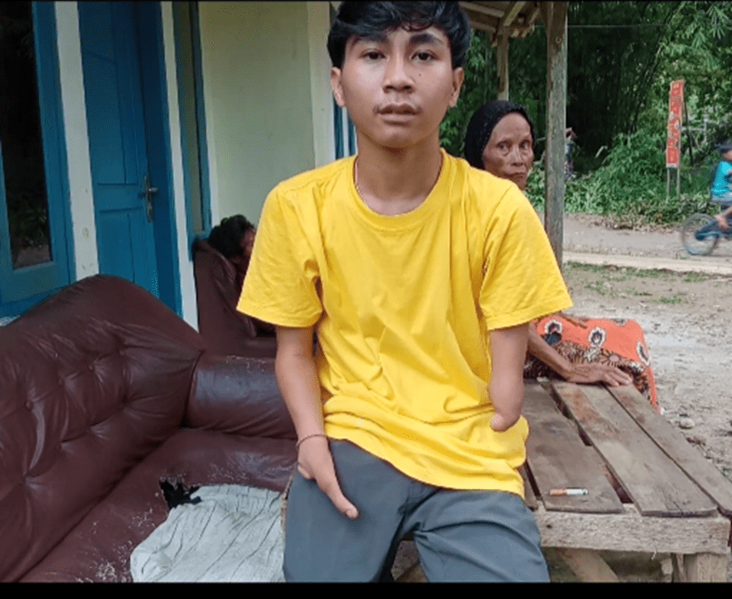 Ikbal Penyandang Disabilitas Inginkan Kaki dan Tangan Palsu