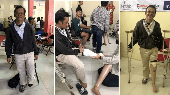 Kaki dan Tangan Palsu Meningkatkan Kehidupan Penyandang Disabilitas