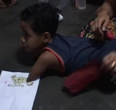 Deni Anak Tanpa Tangan dan Kaki