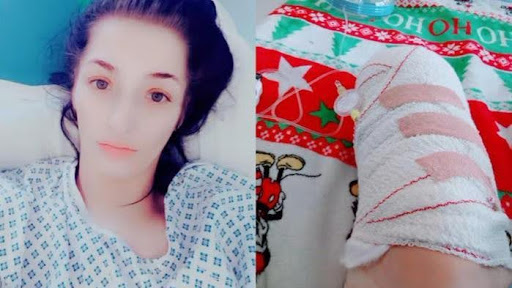 Charlie Terpaksa Amputasi Kaki