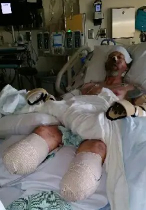 Kondisi Langka, Greg Manteufel Kehilangan Tangan dan Kaki