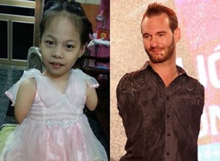 Linh Chi – Gadis Kecil Pemberani Dijuluki “Nick Vujicic” Vietnam