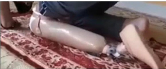 Transtibial Prosthesis untuk Sholat: Studi Kasus Pasien Pasca Amputasi Bawah Lutut