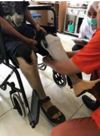 Gambaran Diri Pasien Amputasi Transtibial Setelah Menggunakan Kaki Palsu Komponen ICRC