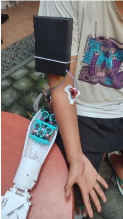 Pengembangan Sistem Pengenalan Gerakan Tangan Prostetik Bionik Menggunakan Sensor EMG, PSD, dan KNN